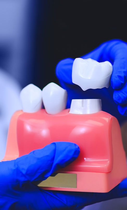 Dental crown cost