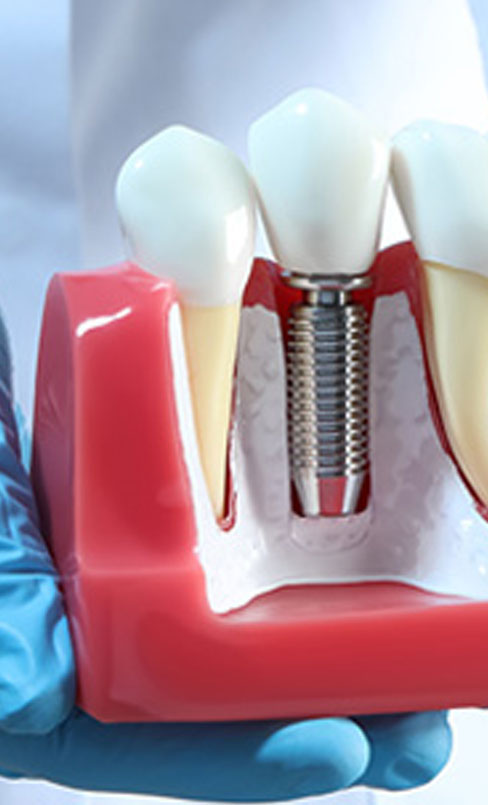 Dental implant consultant
