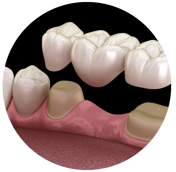 Composite veneers